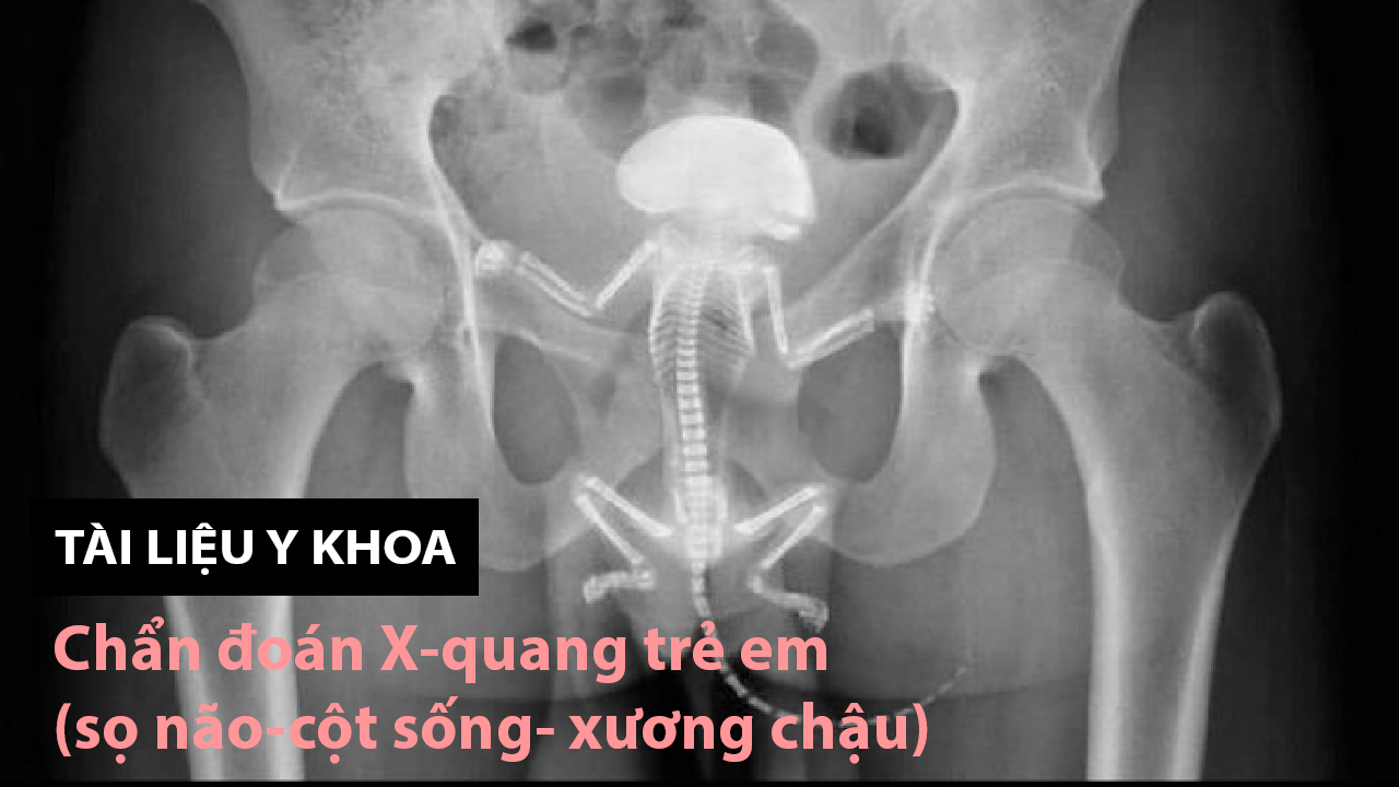 Tài liệu Chẩn đoán X-quang trẻ em (sọ não-cột sống- xương chậu)